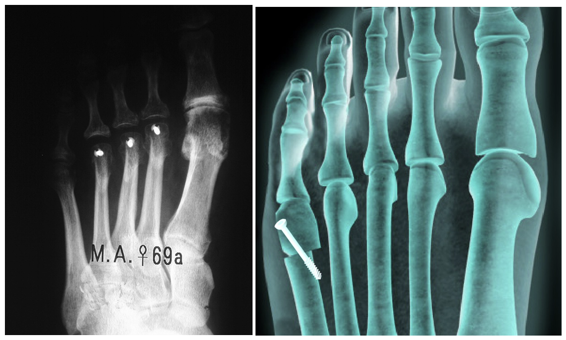 procedures-metatarsal-osteotomies-adrian-talia
